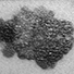 Skin Cancer